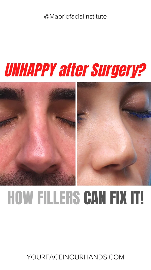 Unhappy with your past rhinoplasty results? You’re not alone. 🤔

In this video, we’re showing how non-surgical rhinoplasty with injectable filler can help enhance or correct previous work. Whether it’s smoothing out imperfections or refining the shape. 👃💉

Have more questions about nose filler? Let us know 💜.

S
T
A
Y

B
E
A
U
T
I
F
U
L

#nonsurgicalrhinoplasty #liquidrhinoplasty #nsr #nonsurgicaltreatments #rhinoplasty #botched #mabriefacialinstitute #sanfrancisco