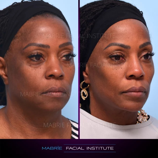 ✨ Cross-country journey ➡️ Full-face glow-up ✨
First-time filler patient. Bodybuilding competitor. Complete transformation. 💖
After watching every MFI video, she flew in from the Midwest ready to start her Illumination 360˚ Full Face Treatment journey. 

🎯 Her goals:
• Lift cheeks that felt like they had fallen with age
• Add volume to the chin
• Balance and refresh her overall appearance ✨

Can you believe we achieved her results over 4 treatment visits in 16 months?!

💉 Treatment: i360˚ Full Face Treatment (ask for it!)
👀 How it works: Strategic dermal filler injections to lift, contour, and restore facial harmony
🎉 Results: Achieved beautifully over 4 treatment visits over 16 months
⏰ Procedure time: About 30 minutes per appointment
📆 Recovery: Slight swelling, tenderness, or bruising — typically resolves within 2–10 days
⏲️ Longevity: Fillers can last several years; yearly touch-ups keep results fresh
(Special touch: she requested Sade during treatment for the perfect vibe 🎶)

Ready to start your journey?
📱 Call/Text: (415) 445-9513
✉️ Email: IG@drmabrie.com

S
T
A
Y

B
E
A
U
T
I
F
U
L

#BeforeAndAfter #Illumination360 #i360FullFace #FirstTimeFiller #BlackGirlMagic #GlowUp #MabrieFacialInstitute #DermalFillers
