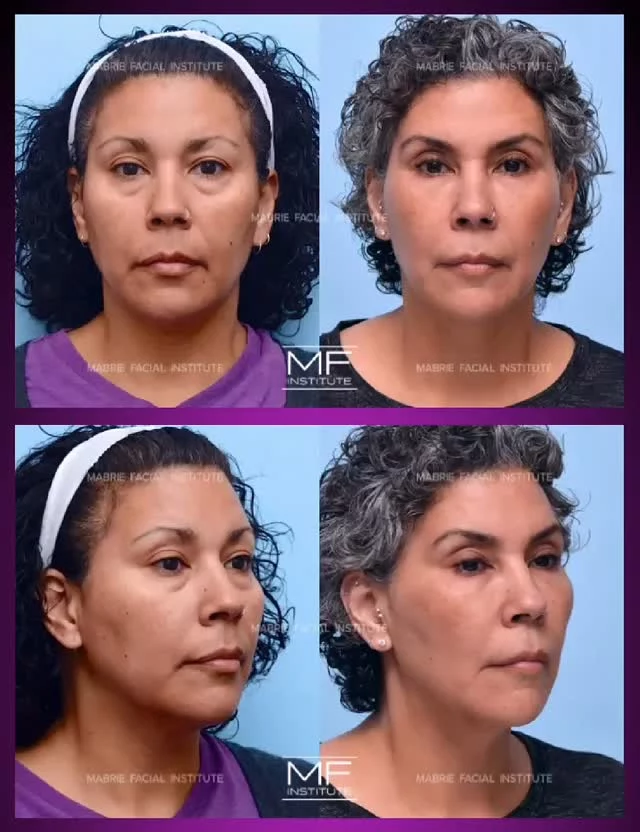 💫i360 Full Face Filler + Botox💫
Our signature Illumination 360° Full Face treatment uses BOTOX and fillers to restore lost volume and contour the face.

📍Location: San Francisco, CA

#undereyefiller #plasticsurgery #dermalfiller #fillers #injectables #mabriefacialinstitute #darkcirlces #lips #nosecontour #bayarea
