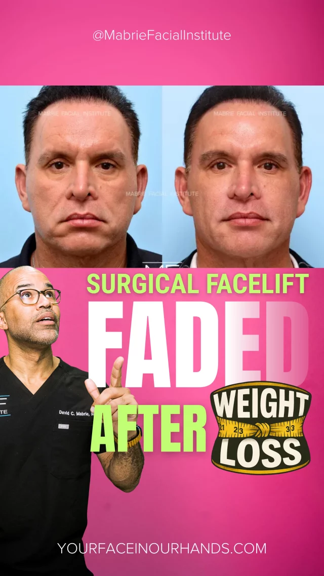 Surgical facelift results don’t always last forever. When changes return, you have options:
▪️Embrace them as part of your natural journey
▪️Choose another surgery for renewed lift
Or...
▪️let i360 Complete Full Face Balancing step in with fillers + Botox like our patient did.

Your journey is yours — we’re here to support it.

Tag someone who needs to see this.

#FacialBalancing #facelift
#NonSurgicalFacelift #UnderEyeFiller #jawlinecontouring