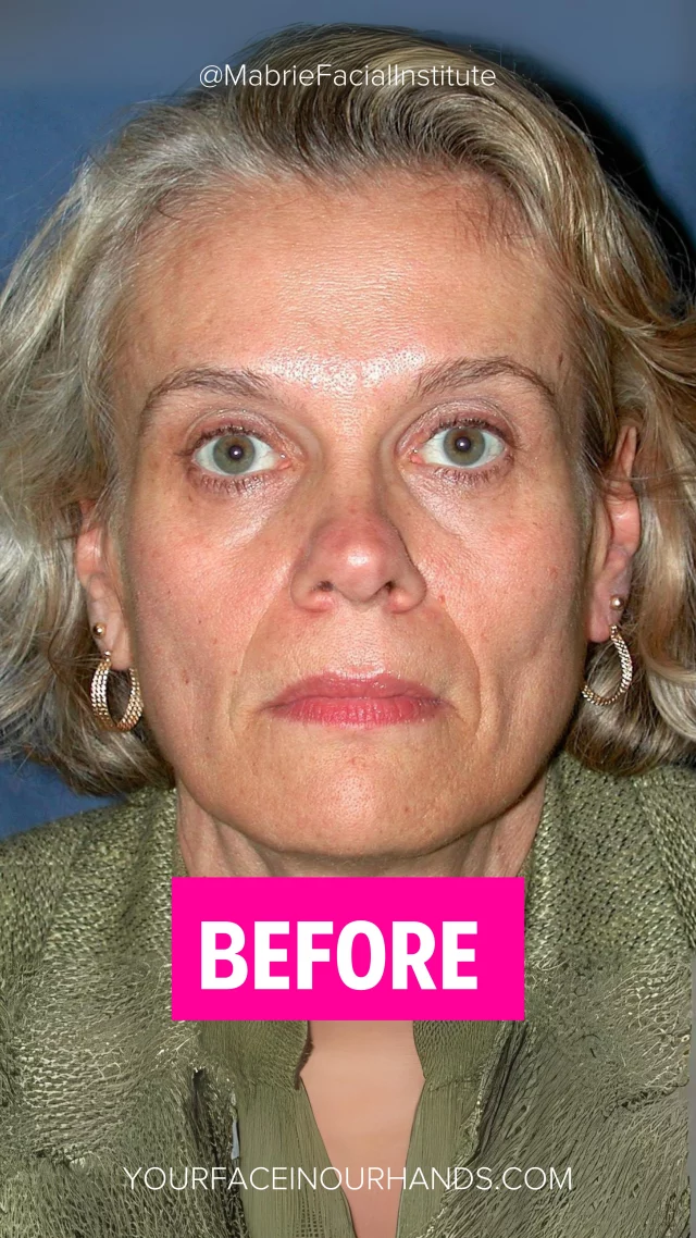Nasolabial folds (smile lines) are natural — but when they stay deep at rest, they can age the face.

At MFl, we know treating just the fold often isn’t enough — we restore support above it (cheeks, midface) to lift and soften the whole area. Watch the video till the end to see how it works!

Tag someone who needs this!

#smilelines #nasolabialfolds #antiaging #dermalfiller #plasticsurgery