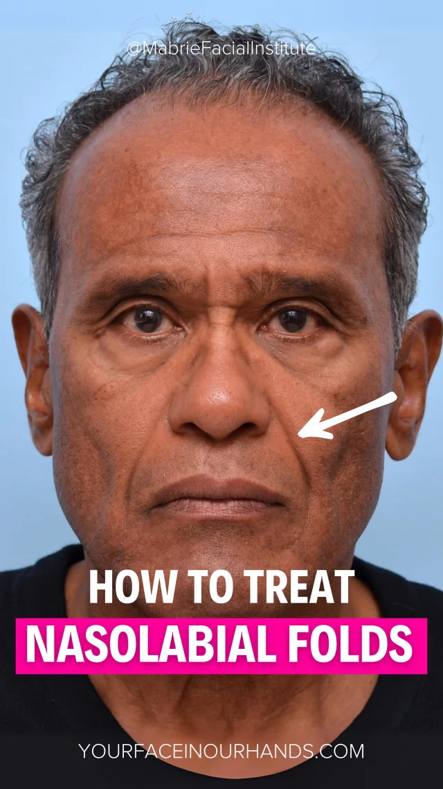 Nasolabial Folds, Smile Lines, Laugh Lines…
These Lines That Age You the Most — Here’s How We Fix Them 🙂

Tag someone who needs to see this! 

S
T
A
Y

B
E
A
U
T
I
F
U
L

#aesthetics #dermalfiller #smilelines #antiaging #plasticsurgeon #facialplasticsurgeon
