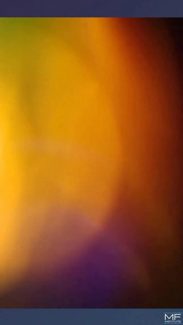 A lot of patients are scared of getting filler — and we get it.
You’ve seen the bad work out there.

But filler isn’t the problem — technique is.
Faces aren’t flat. They’re three-dimensional works of art — and that’s how they should be treated.

Too often, injectors focus on one area instead of the whole face.

Watch how facial plastic surgeon Dr. Mabrie uses the i360 F.A.C.E. method to create results that look natural, balanced, and cohesive.

✨ For those who are new here — welcome!
We specialize exclusively in filler. Follow along to learn how artistry and surgical precision come together to create beautiful, natural-looking results.

We know filler isn’t for everyone — and that’s okay.
But in the right hands, it’s a powerful tool that enhances what’s already beautiful and helps you look like you.

What do you think of this treatment approach? Tell us in the comments 👇

#fillers #fillertreatment #facialrejuvenation #facelift #fillerinjections #fillereducation #i360FACE