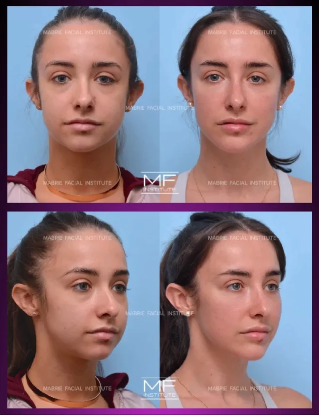 Fillers in your 20s - it’s NOT about changing your face; it’s about supporting it as you age.

8 years. 8 treatments. i360 Full Face @mabriefacialinstitute 

Each treatment built gracefully on the last, enhancing her structure, balancing key areas, without altering her essence.

Here’s what we treated over time:
• Chin, lips, and non-surgical rhinoplasty
• Midface + cheek support
• Under-eye filler for a brighter, rested look
• Jawline contouring
• BOTOX to the upper face and mentalis for balance

What’s your beauty routine?

#aesteticmedicine #fillerbeforeandafter #fillerinjections