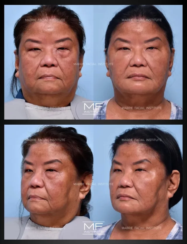 This patient in her 60s DIDN’T want surgery. Here is what we are able to do @mabriefacialinstitute with our Illumination 360˚ Full Face Treatment non surgically.

With a full-face approach, every feature is evaluated together so we can restore support where it matters most.

We used dermal filler and BOTOX to rejuvenate and contour her face for balanced, natural-looking results.

💋Can you guess all the areas we treated? 

#i360FullFace #mabriefacialinstitute #undereyefiller #marionettelines #jawlinecontouring #facialplasticsurgery #injectables #fullfacebalancing