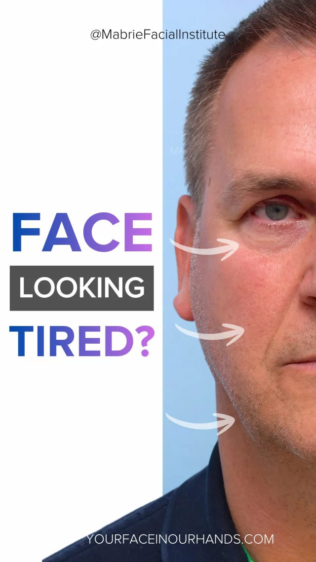 🔥For the guys: filler isn’t about looking “done.”
It’s about looking sharp.🔥

If you want to look refreshed, not “filled”, you’re in the right place. 

Over 8 months and 3 visits, his i360 Full Face treatment @MabrieFacialInstitute included:

▪️Fillers to the forehead, under-eyes, midface + cheeks, marionette lines, lips, nose, chin + jawline
▪️BOTOX to the upper face, chin, and parotid glands for subtle facial slimming

This is how men look refreshed — not “filled.”

👉 Ready to upgrade how you show up? 
DM or call 415-445-9513 to schedule a consultation.

Follow us for more i360 Full Face results.

S
T
A
Y

B
E
A
U
T
I
F
U
L

#antiaging #antiagingtreatment #menshealth #menbeauty #skincareroutine #undereyefiller #fillerssf #darkcircles #jawlinefiller #jawlinecontouring