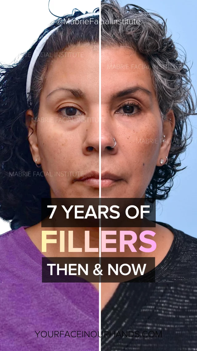 7 years of full face filler… and she still looks like HER.
Say goodbye to under eye bags and dark circles.  Dare we say, “send those bags packing”? 🧳
 
Our i360 Full Face is our non surgical remedy for facial rejuvenation using injectables and BOTOX. 

Her treatment over the years included:
• Under-eye filler to soften dark circles
• Midface + cheek support
• Chin contouring 
• Jawline definition 
• Corner-of-mouth shadow reduction
• BOTOX for smooth, natural expression
 
A patient for 7 years – her results look fresh, never over done. 
 
Ready for your i360 Full Face transformation?
DM us for your private, in-person or online consultation.

#aginggracefully #darkcircles
#rejuvention fillers botox nonsurgical mabriefacialinstitute i360FullFace aesthetics undereyebags undereyecircles fillers