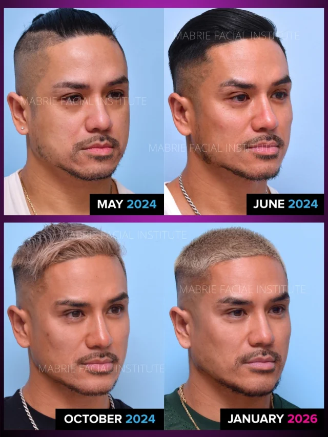 😍Our Illumination 360° Full Face Filler Transformation

May 2024 → 2026.

Results like this don’t happen in one visit. That’s the part people don’t always see. It’s not one big appointment. It’s adjusting, letting it settle, refining when it makes sense.

And once you’re where you want to be?
It’s not about adding more and more. It’s light maintenance every year or two to keep things balanced.

Also… the haircut upgrade didn’t hurt. ☺️

It’s subtle. But it adds up.

Can you tell what we treated?

#i360FullFace #facialrejuvenation #faceliftexpert #dermalfiller