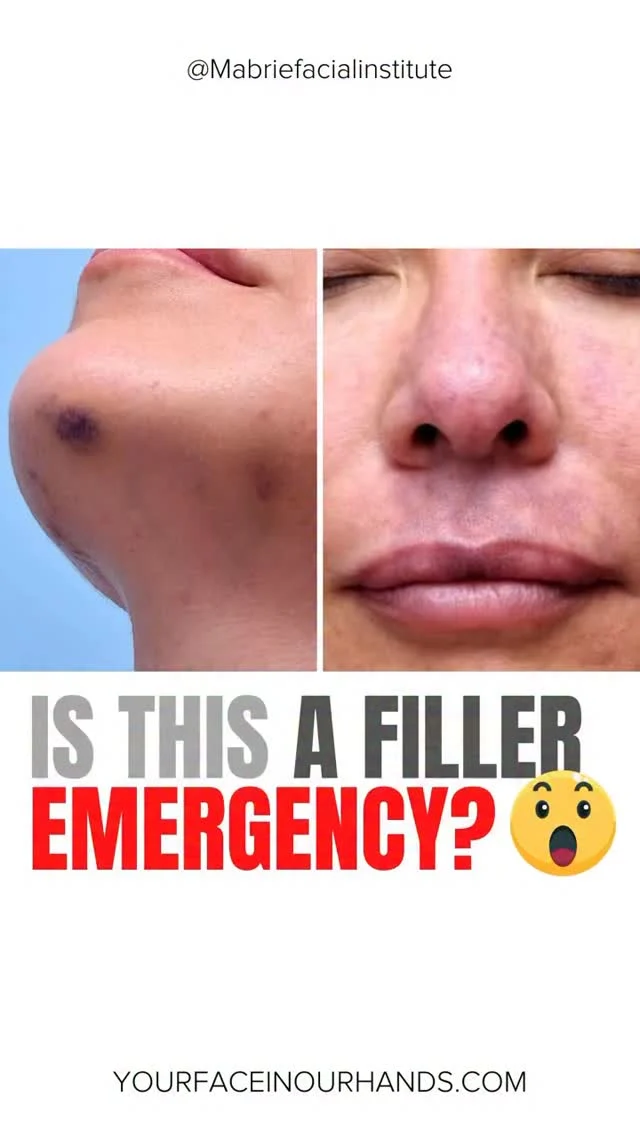 Bruising? Redness? Pain? 🤔 After dermal filler injections, is it normal… or an emergency? 🚨

Dr. Mabrie breaks it down: when to stay calm and when to call your injector immediately. Your safety is always a top priority!

👉 Tag and share this with your friend who gets filler. 
 
#fillers💉 #sideeffects #bruising #vascularocclusion  #filleraftercare