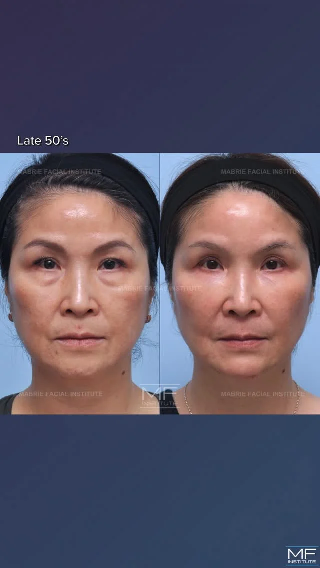 BOTOX & Filler in your 60s? ABSOLUTELY!
Looking refreshed is timeless.

This incredible patient came to us wanting to improve under eye puffiness and bags. She was ready for a real, noticeable shift without surgery.

With our Illumination 360˚ Facial Analysis, we mapped the structural areas that needs support and created a plan that would revive her expression.

Using BOTOX and strategically placed dermal filler, we subtly treated:
🔸 midface & cheeks
🔸 tear troughs
🔸 chin

Millimeters made the difference. The result? A fresher, brighter, fully "hers" version of her face.

💜 Curious about what Illumination 360˚ can do for you? Send us a DM or tap the link in our bio to begin your consultation.  Your glow era starts now.

#i360FullFace #dermalfillers #nonsurgical #nosurgery #SanFrancisco
