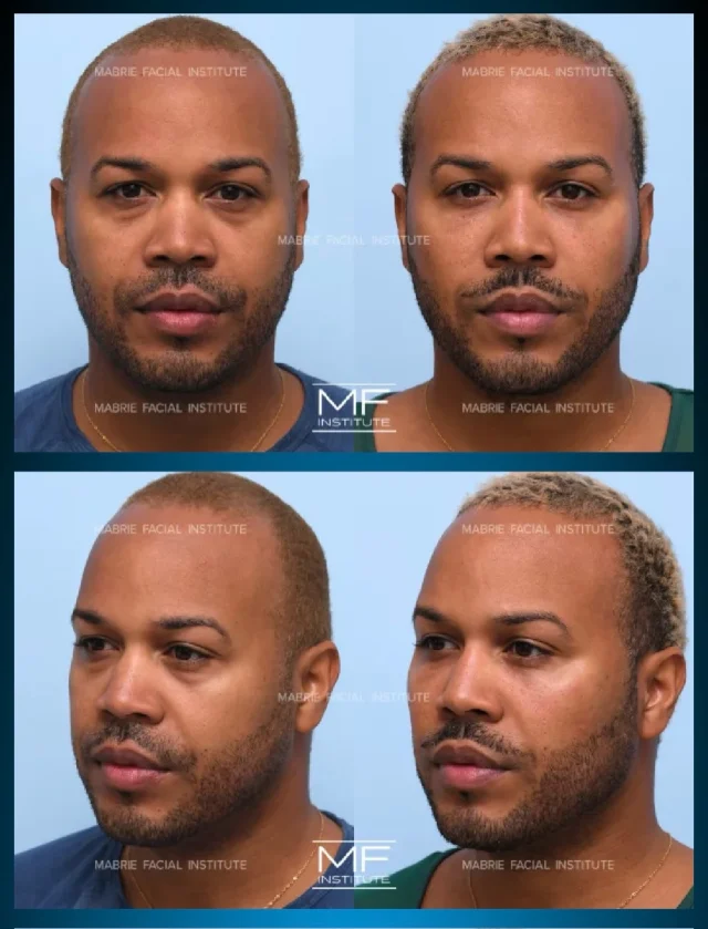 Under Eye Filler Results @mabriefacialinstitute 

📍Location: San Francisco

#undereyefiller #plasticsurgery #dermalfiller #fillers injectables mabriefacialinstitute darkcirlces bayarea