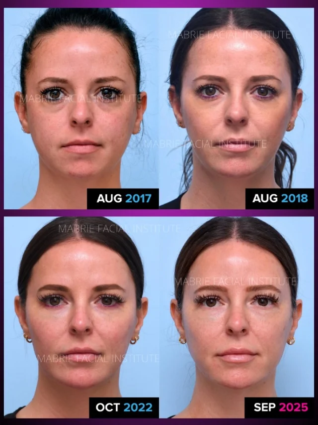 It’s NOT about changing your face; it’s about supporting it as you age.

8 years. Multiple Treatments. 

Rather than treating individual features in isolation, we evaluate how filler is affecting the entire face including contour, light, shadow, and proportion. 

This is a results-driven medical process focused on restoring harmony and balance using our Illumination 360˚ Evaluation and treatment approach.

Each treatment built gracefully on the last, enhancing her structure, balancing key areas, without altering her essence.

Check out our website to see what we treated over time.