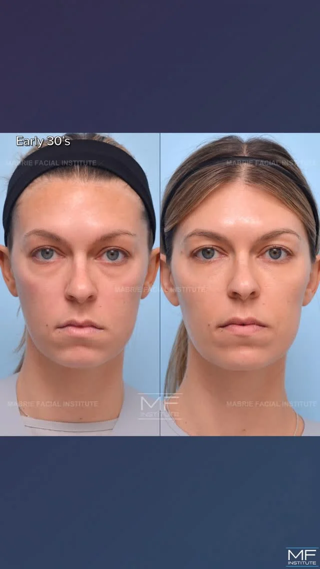 Breakthrough: Under eye bags are usually misunderstood and don't automatically mean surgery.
They don't mean "just fill the hollow" either.

Correcting under eye bags without surgery requires strategy.

By addressing the midface, cheeks, chin, and the under eye together, we restored balance and refreshed her entire face.

Subtle changes. 👉🏾 Meaningful difference.

This is the difference between adding filler and designing a comprehensive treatment plan.

Precision over shortcuts. Always!

💜 Follow for  experience-driven education on injectables.

#undereyefiller #undereyecircles #undereyebags #teartroughfillers #aestheticmedicine💉