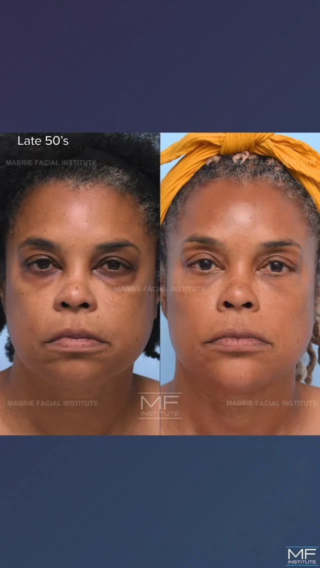 The mistake most injectors make when treating under eye bags? Treating the wrong place.

Dark circles and under eye bags don't exist in isolation. Restoring support in the right places - not just "filing the hollows" allows the entire area to soften.

👉🏾 No heavy cheeks.
👉🏾 No overfilled look.
😍 Just better balance and smoother transitions that reflect light.

When the midface and cheek are supported properly with subtle structure, strategic injectable placement, and the right treatment plan, results are natural-looking and refreshing. 

💜 Follow for more expert insights on why injectables fail and when they truly work.

#undereyefiller #undereyecircles #undereyebags #teartroughfillers #aestheticmedicine💉 #hyaluronic_acid #i360FullFace #nonsurgical #nonsurgicalfacelift #FacialBalancing