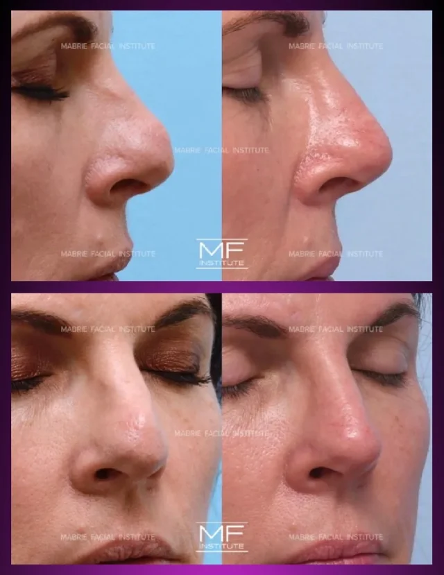 She'd already been through surgery. Twice.

And she still wasn't happy with her nose. Not every nose needs another surgery.

After a surgical rhinoplasty, small irregularities can show up—edges, dips, asymmetries.

Rather than go back under the knife, she came to us and filler did what surgery couldn't. No downtime. No scalpel. Just a nose she finally loves. 💜

Had a Rhinoplasty or filler? What’s been your experience?