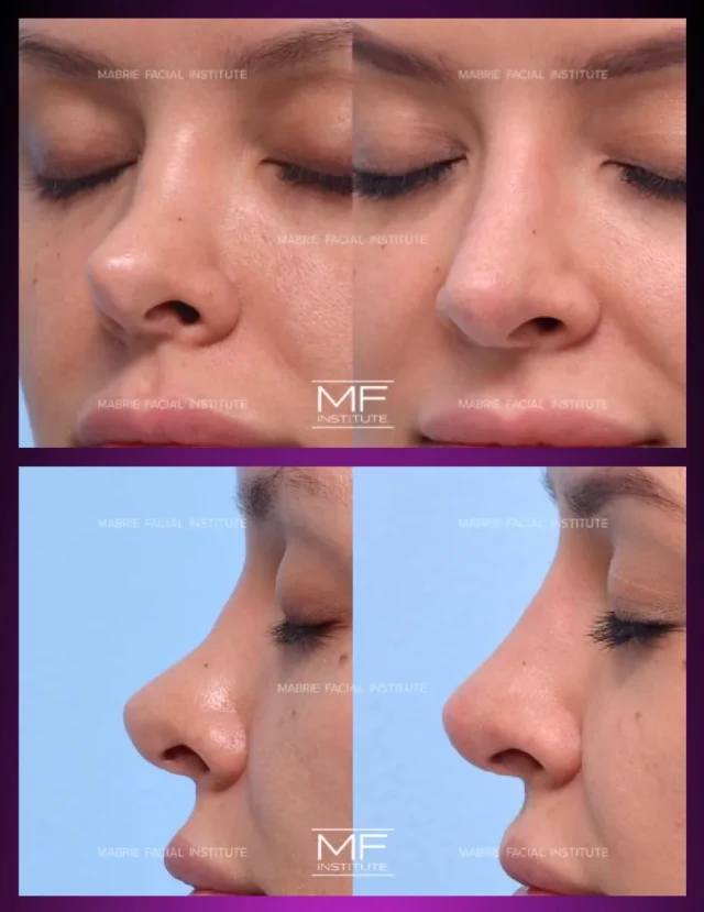 Correcting nasal asymmetry following a previous surgical rhinoplasty. 

Comment „nose“ to learn more. 

#nonsurgicalrhinoplasty #liquidrhinoplasty
#nonsurgicalnosejob