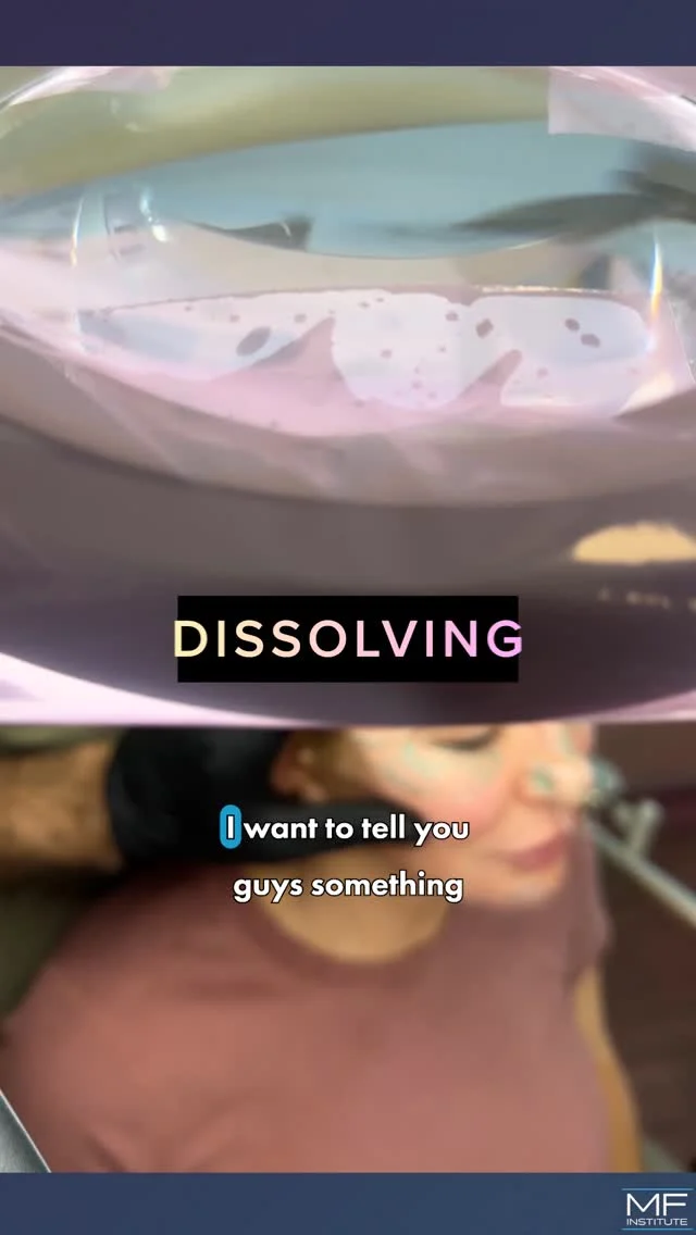 This Could've Been Avoided - Technique Changes Everything

Fillers don't fail on their own. They fail when technique misses the mark.
👉🏾 Lumpiness and blue tint under the eyes.
👉🏾 Cheeks that look uneven or heavy.
👉🏾 Results that feel and look off instead of balanced.

This isn't "bad filler", it's filler placed without the right depth, strategy, or full-face plan.

In this patient, dissolving poorly placed filler was a reset.

This is the part most people don't hear:
Product matters - but technique matters more.
When the technique if right, filler can do exactly what it's meant to do. Refresh and revive tired under eyes.

💜 Share with a friend who needs to hear this!

#undereyefiller #undereyecircles #undereyebags #teartroughfillers