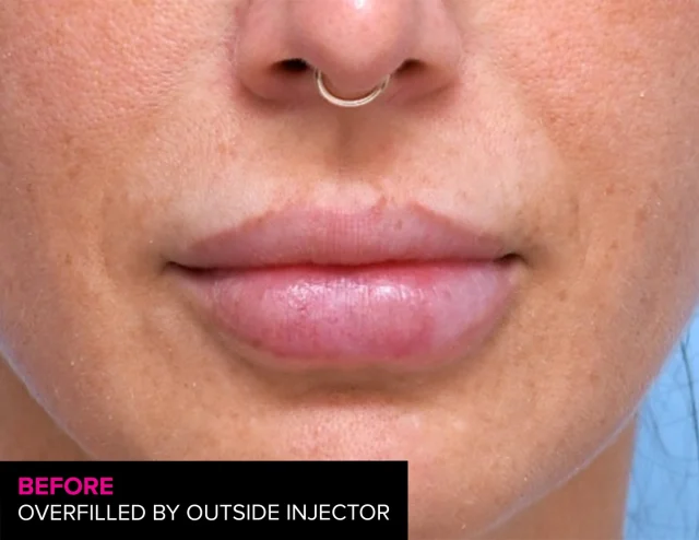 When multiple lip treatments from an outside injector left her latest results overfilled with filler outside the natural lip line. 

Poor technique. Overfilled. 

👉🏾Dissolved. Redone right. Not every lip filler result is perfect. Sometimes you just need to dissolve and start again.

#lipfiller #lips #lipcontour #perfectpout