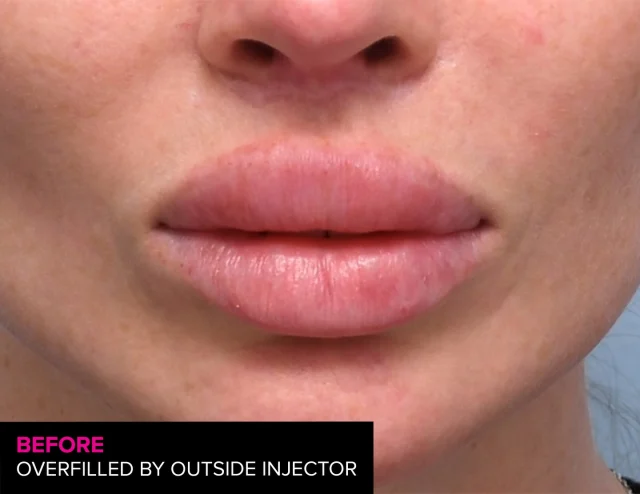 💋From Overfilled and undefined to
Crisp and defined lips💋

Overfilled. Dissolved. Redone right. Not every lip filler result is perfect. Sometimes you just need to dissolve and start again.

#lipfiller #lips #lipcontour #perfectpout