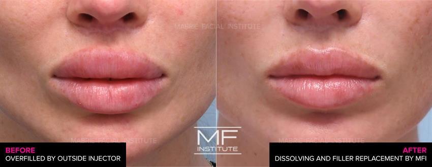Lip Fillers Before After Photo