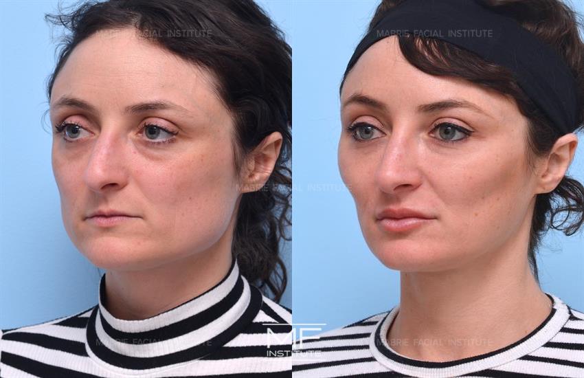 SLIM FACE EXERCISE  Reduce Chubby Cheeks, Double Chin, Get Sharp Jawline,  Lift Up Your Face 