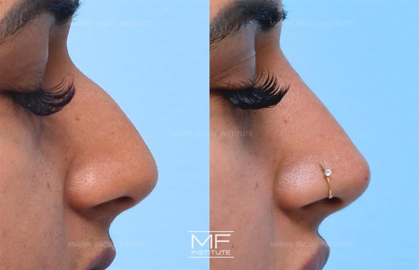 Nose Reshaping Without Surgery In San