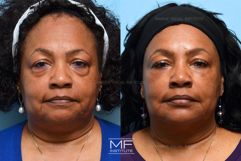 before and after non surgical facelift in san francisco, case #406