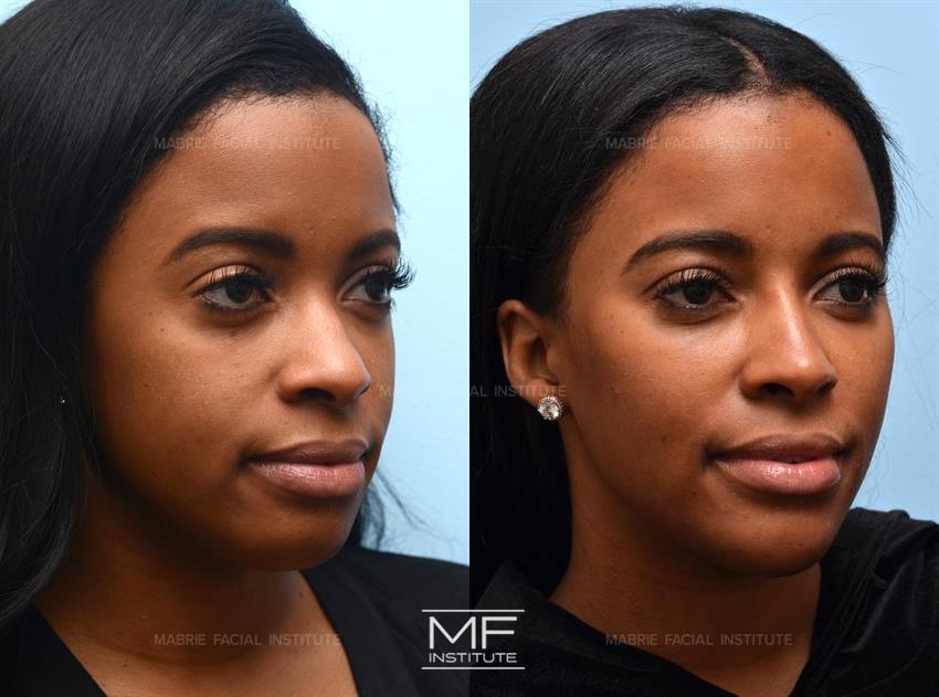 Jawline Filler for Definition & Contour (Updated 2023) – Mabrie Facial  Institute