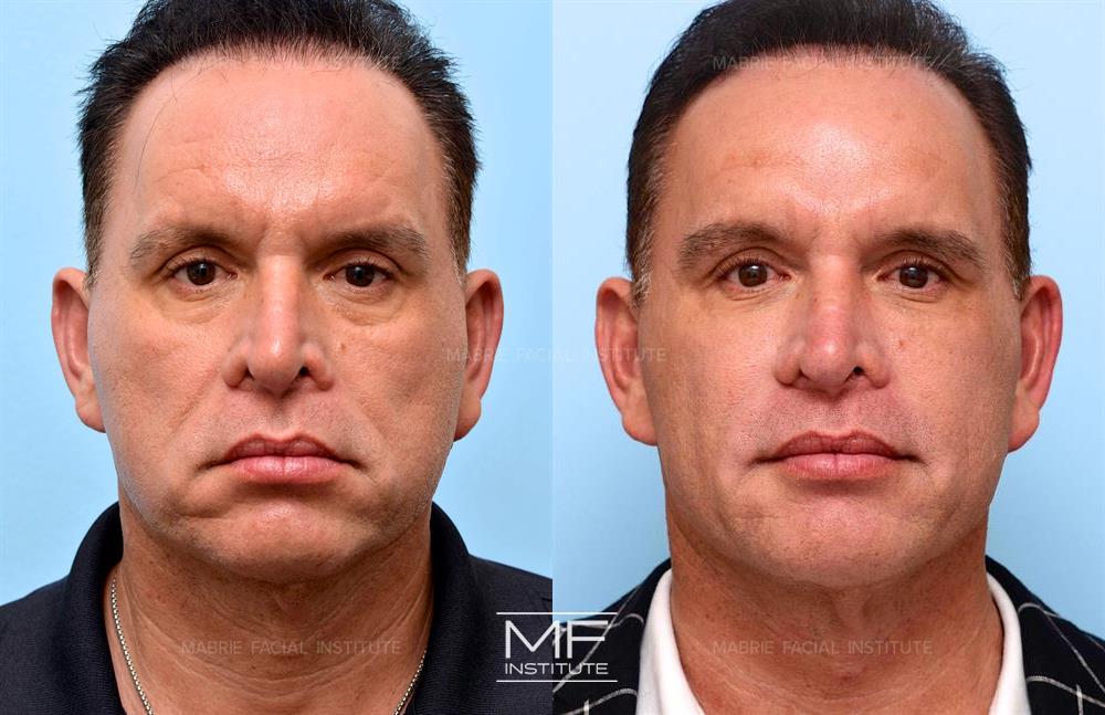 before and after non surgical facelift in san francisco, case #433