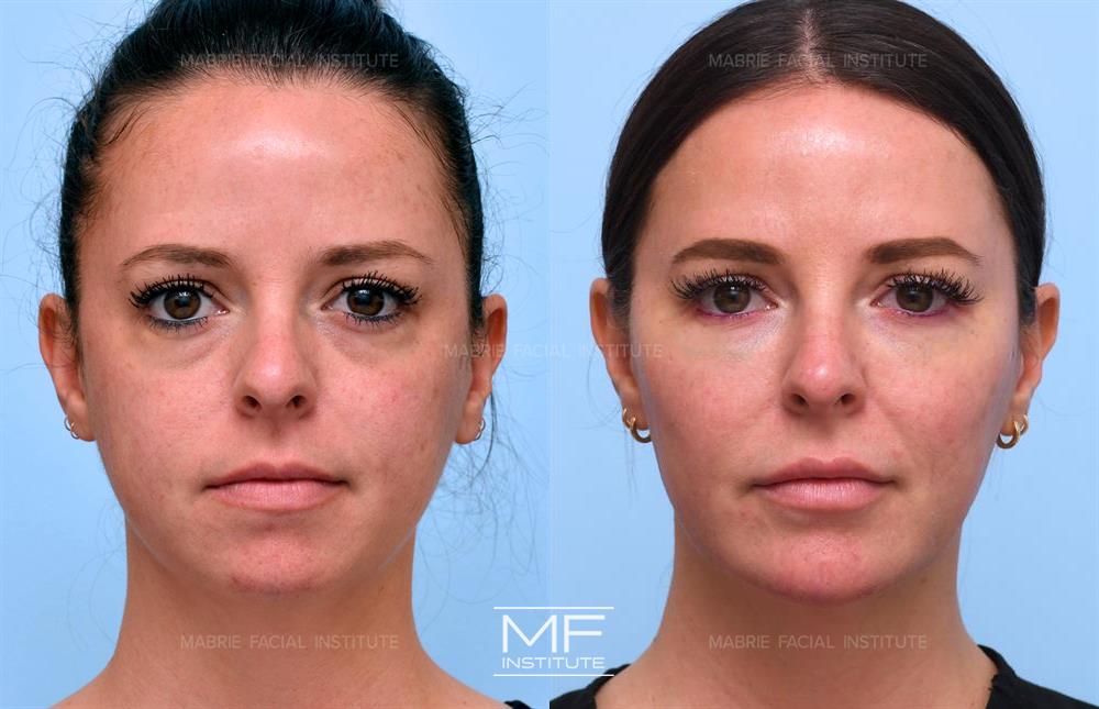 Nonsurgical facelift before and after, case #434