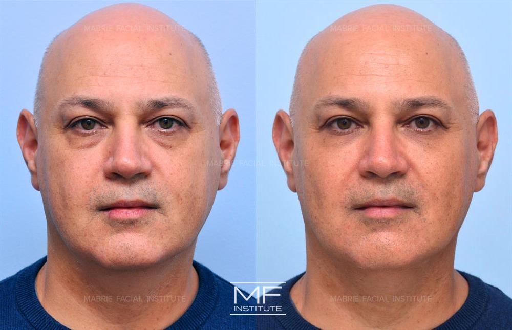 before and after under eye filler for men in San Francisco at Mabrie Facial Institute