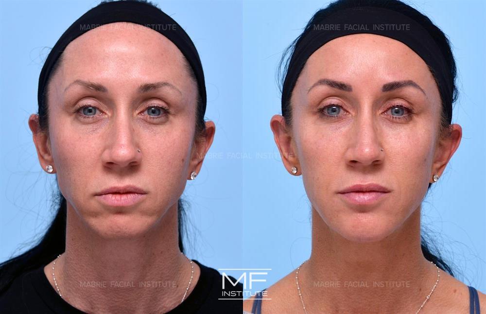 Nonsurgical facelift before and after, case #624