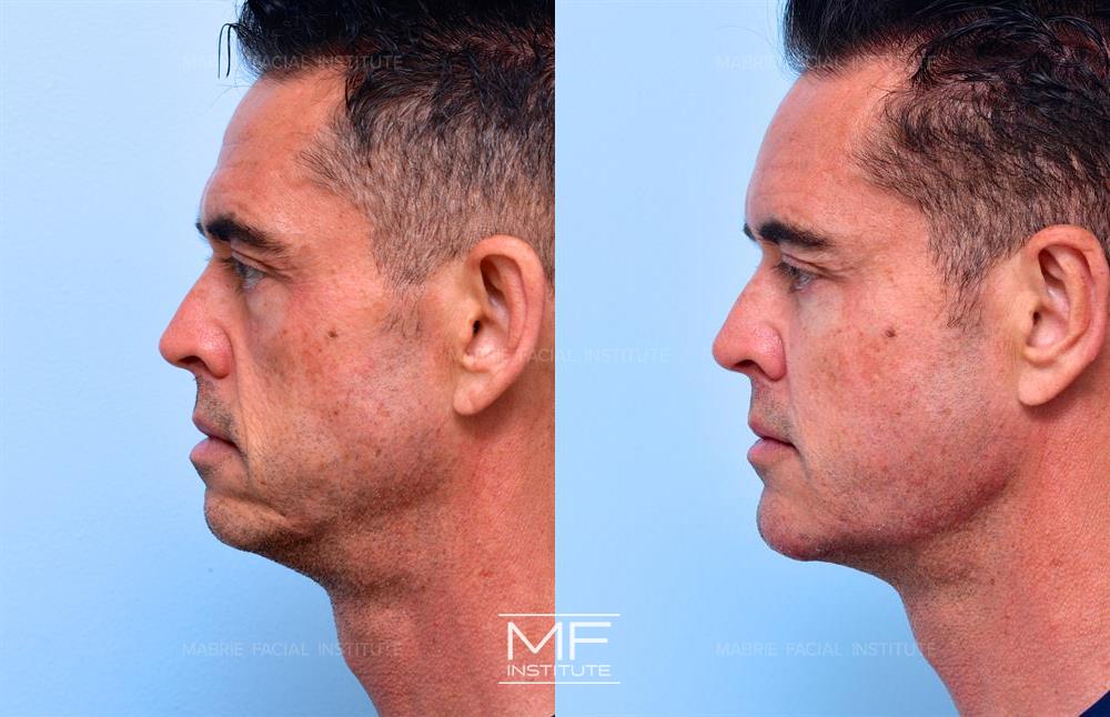 non surgical facelift in san francisco before and after, case #645