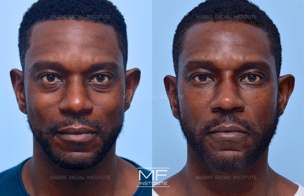 before and after under eye filler for men in San Francisco at Mabrie Facial Institute