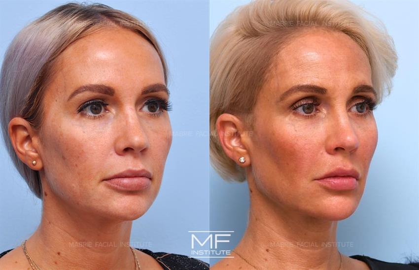 Juvederm Before and After Pictures