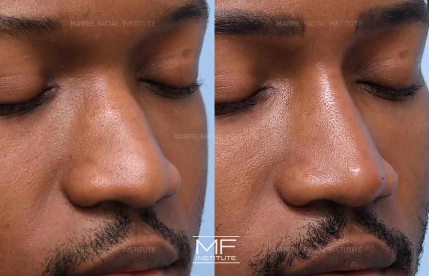 Nose Reshaping Without Surgery in San Francisco
