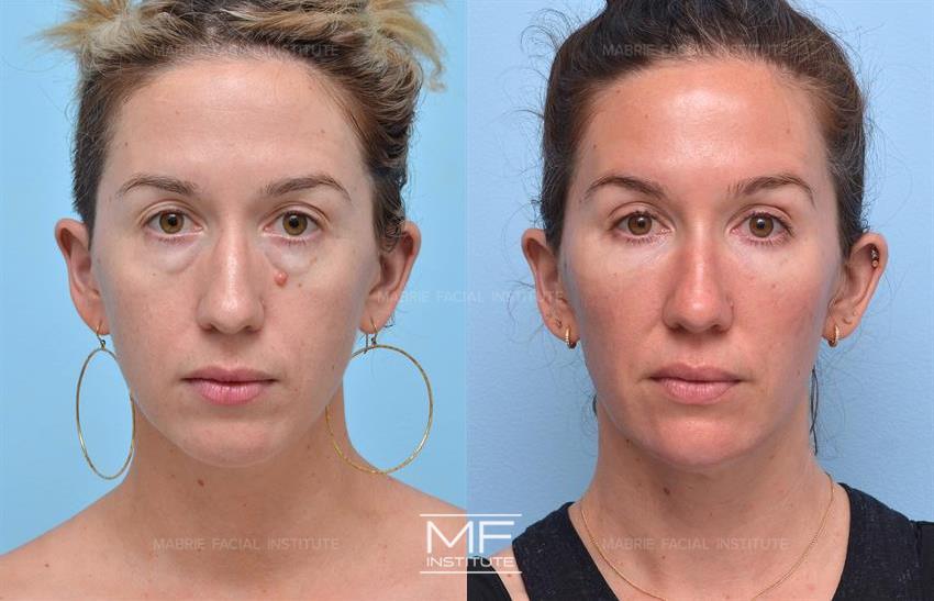 Under-Eye Filler / Midface Rejuvenation Before & After Photo