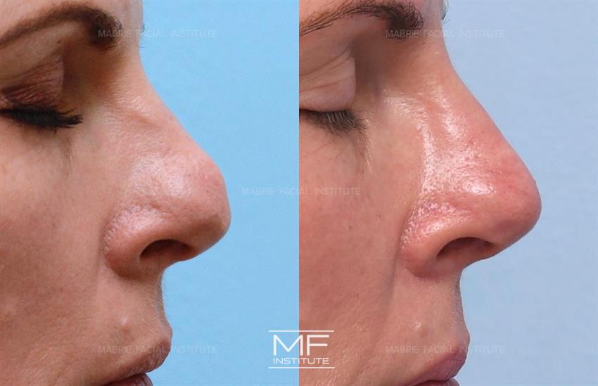 How to Get Masseter Botox Covered by Insurance: Insider Tips