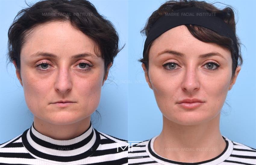BOTOX® for Masseter & Jaw Before & After Photo Gallery, San Francisco, CA